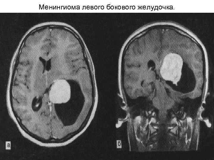 Менингиома левого бокового желудочка. 