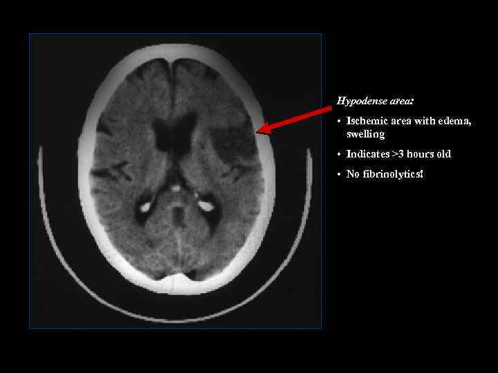 Hypodense area: • Ischemic area with edema, swelling • Indicates >3 hours old •