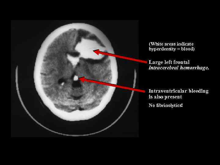 (White areas indicate hyperdensity = blood) Large left frontal intracerebral hemorrhage. Intraventricular bleeding is