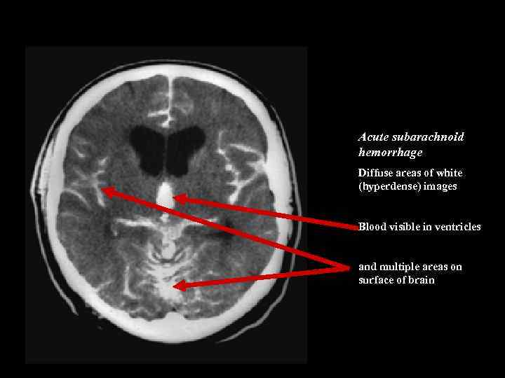 Acute subarachnoid hemorrhage Diffuse areas of white (hyperdense) images Blood visible in ventricles and