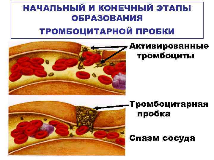 НАЧАЛЬНЫЙ И КОНЕЧНЫЙ ЭТАПЫ ОБРАЗОВАНИЯ ТРОМБОЦИТАРНОЙ ПРОБКИ Активированные тромбоциты Тромбоцитарная пробка Спазм сосуда 
