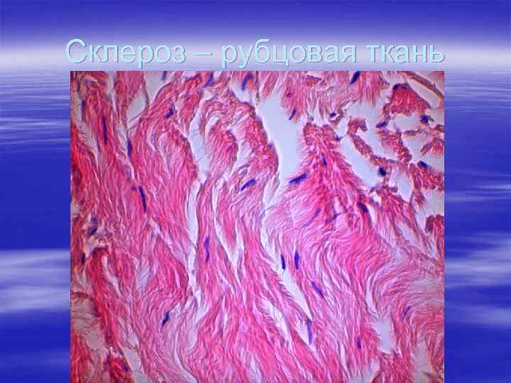 Склероз – рубцовая ткань 