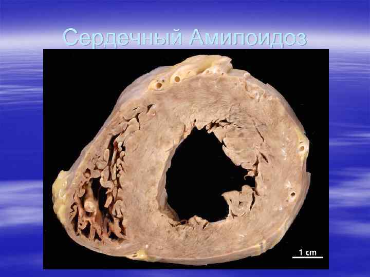 Сердечный Амилоидоз 