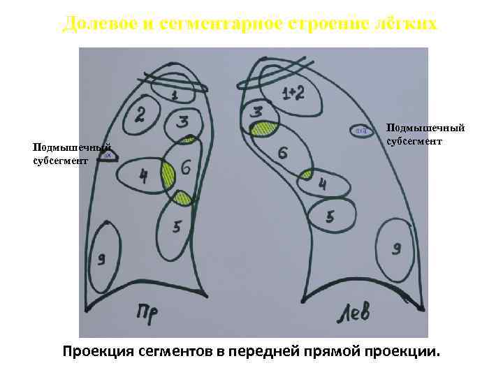 Долевое и сегментарное строение лёгких Подмышечный субсегмент Проекция сегментов в передней прямой проекции. 