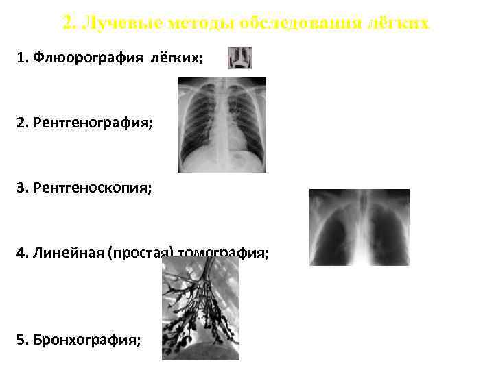 2. Лучевые методы обследования лёгких 1. Флюорография лёгких; 2. Рентгенография; 3. Рентгеноскопия; 4. Линейная