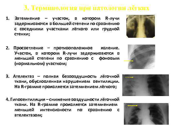 3. Терминология при патологии лёгких 1. Затемнение – участок, в котором R-лучи задерживаются в