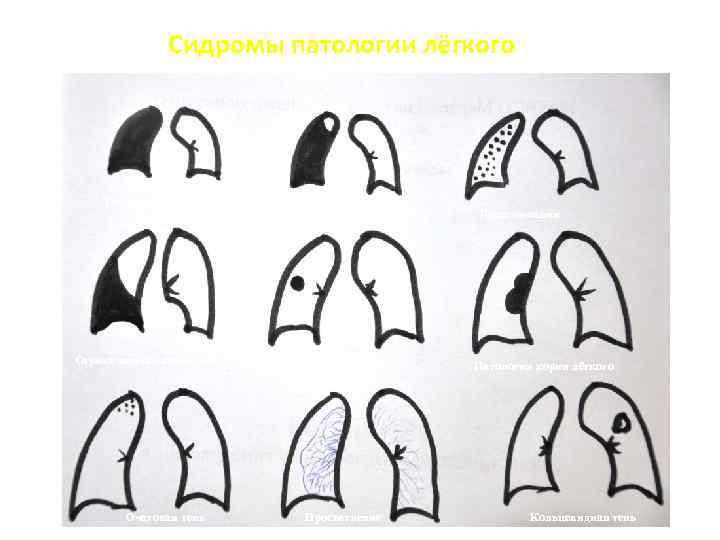 Сидромы патологии лёгкого е Тотальное затемнение Ограниченное затемнение Очаговая тень Субтотальное затемнение Круглая тень