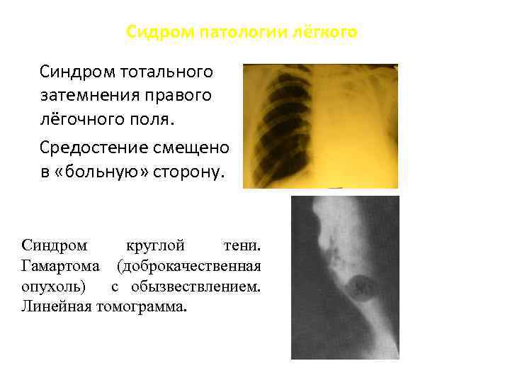 Сидром патологии лёгкого Синдром тотального затемнения правого лёгочного поля. Средостение смещено в «больную» сторону.