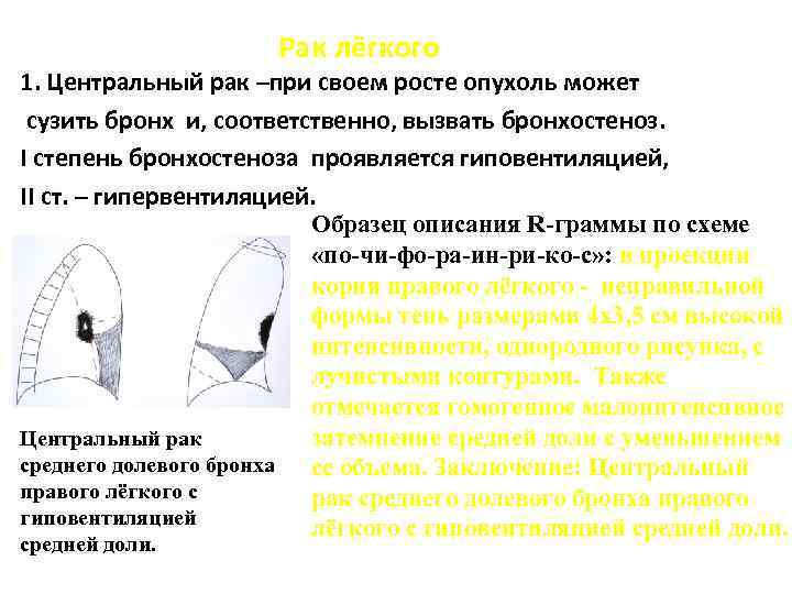 Рак лёгкого 1. Центральный рак –при своем росте опухоль может сузить бронх и, соответственно,