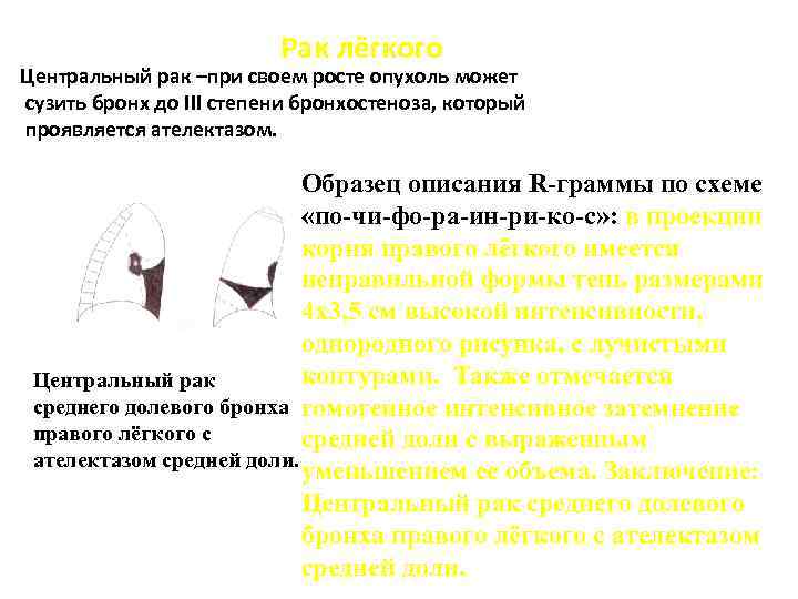 Рак лёгкого Центральный рак –при своем росте опухоль может сузить бронх до III степени