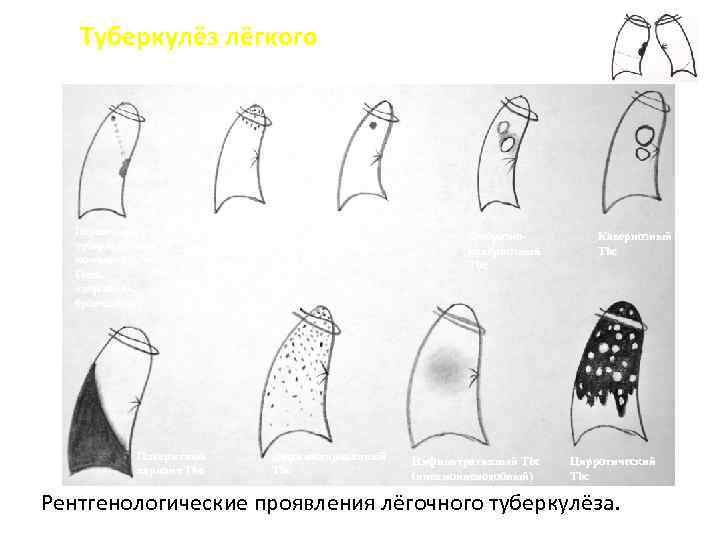 Туберкулёз лёгкого Туберкулёзный лимфаденит Первичный туберкулёзный комплекс. Очаг Гона, «дорожка» , бронхаденит. Очаговый Tbc