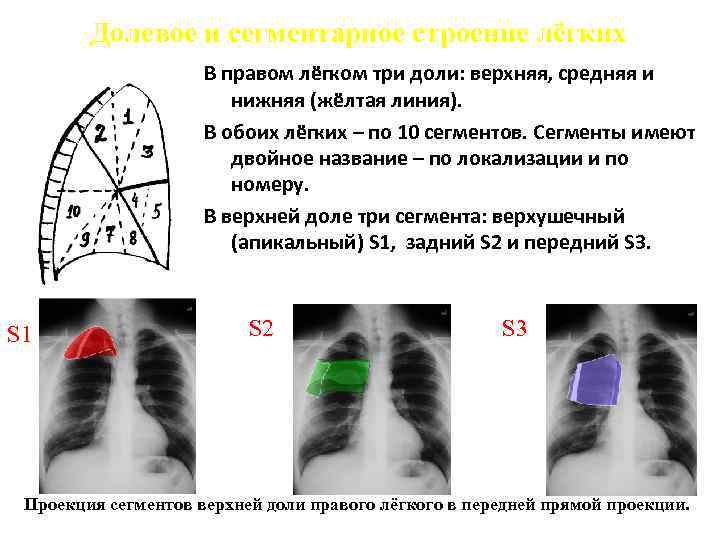 Пневмония верхней доли легкого. Очаговая пневмония средней доли правого легкого. Доли легкого s1 s2. Сегменты s1 s2 легких. Доли легких на рентгенограмме.