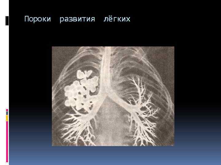 Пороки развития лёгких 