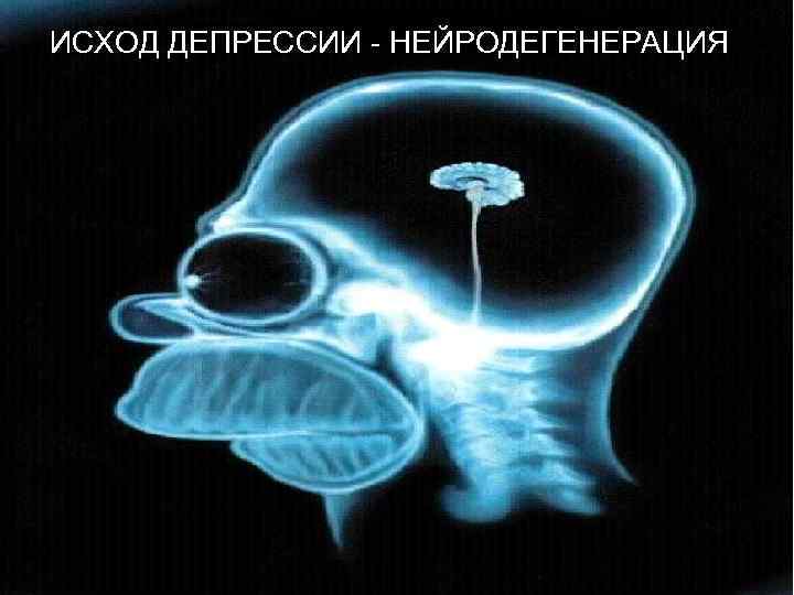 ИСХОД ДЕПРЕССИИ - НЕЙРОДЕГЕНЕРАЦИЯ 