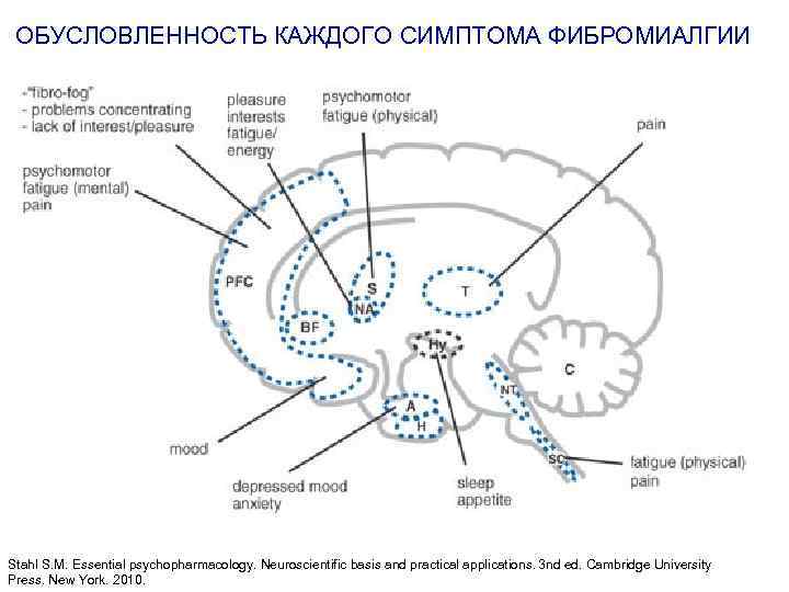 ОБУСЛОВЛЕННОСТЬ КАЖДОГО СИМПТОМА ФИБРОМИАЛГИИ Stahl S. M. Essential psychopharmacology. Neuroscientific basis and practical applications.