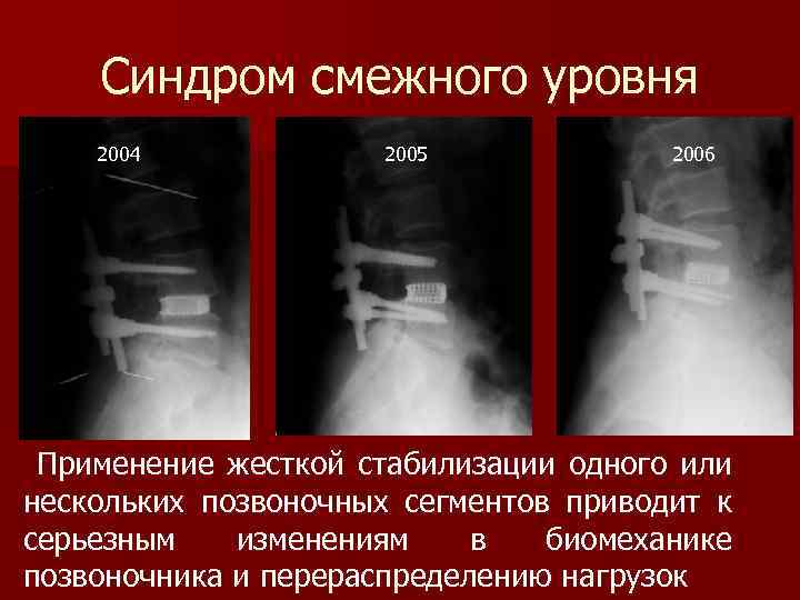 Синдром смежного уровня 2004 2005 2006 Применение жесткой стабилизации одного или нескольких позвоночных сегментов