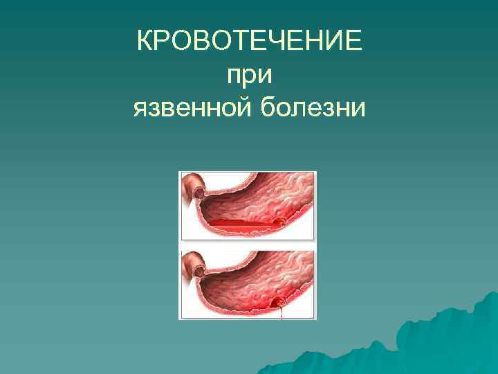 КРОВОТЕЧЕНИЕ при язвенной болезни 