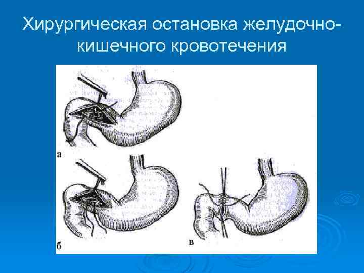 Хирургическая остановка желудочно кишечного кровотечения 