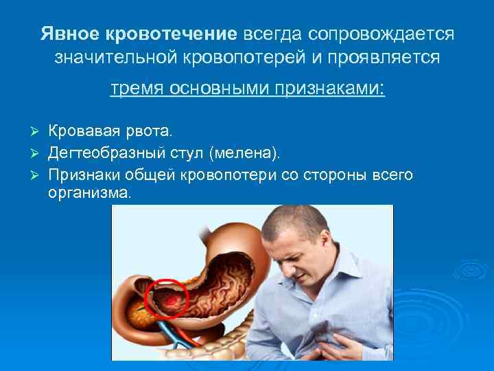 Явное кровотечение всегда сопровождается значительной кровопотерей и проявляется тремя основными признаками: Кровавая рвота. Ø