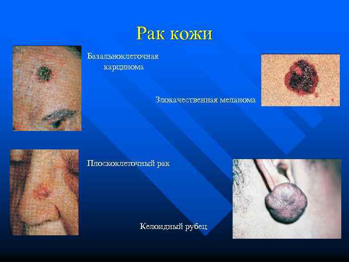 Рак кожи Базальноклеточная карцинома Злокачественная меланома Плоскоклеточный рак Келоидный рубец 