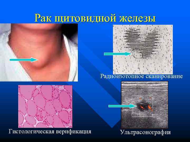 Рак щитовидной железы Радиоизотопное сканирование Гистологическая верификация Ультрасонография 