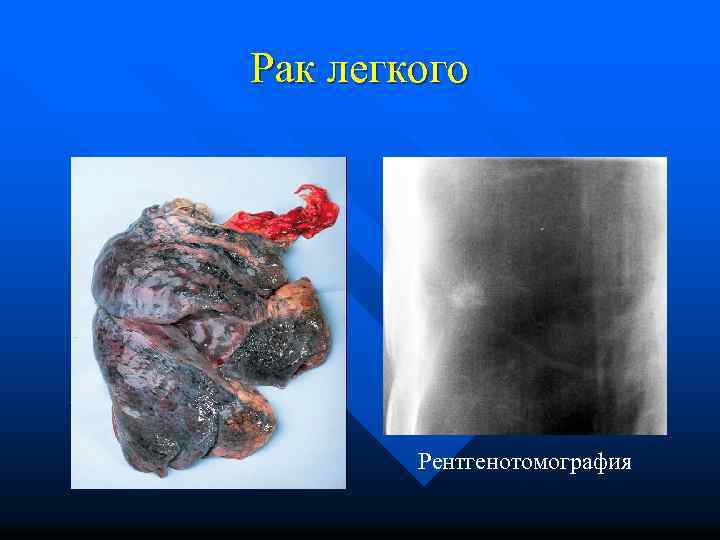 Рак легкого Рентгенотомография 