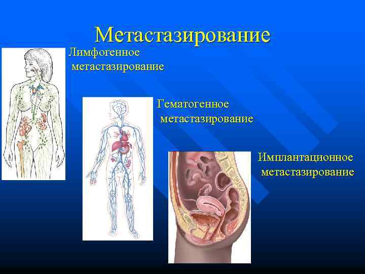 Метастазирование Лимфогенное метастазирование Гематогенное метастазирование Имплантационное метастазирование 
