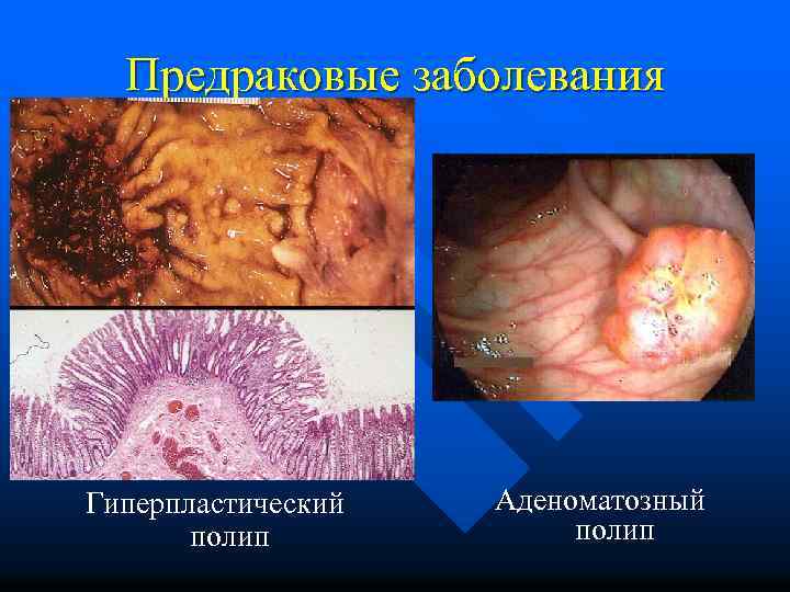 Предраковые заболевания Гиперпластический полип Аденоматозный полип 