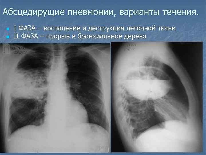 Абсцедирущие пневмонии, варианты течения. n n I ФАЗА – воспаление и деструкция легочной ткани