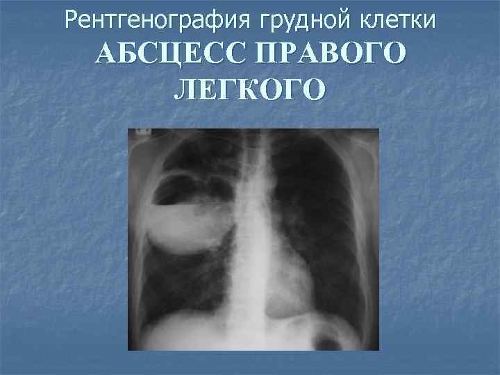 Рентгенография грудной клетки АБСЦЕСС ПРАВОГО ЛЕГКОГО 
