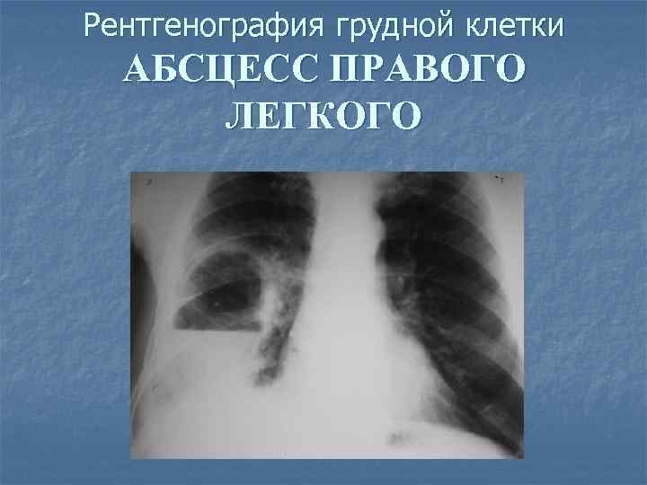 Рентгенография грудной клетки АБСЦЕСС ПРАВОГО ЛЕГКОГО 