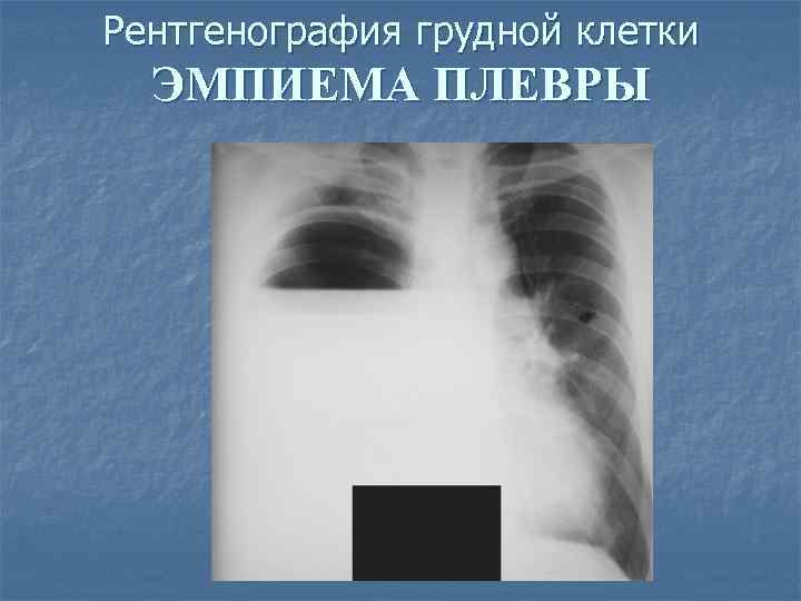 Рентгенография грудной клетки ЭМПИЕМА ПЛЕВРЫ 
