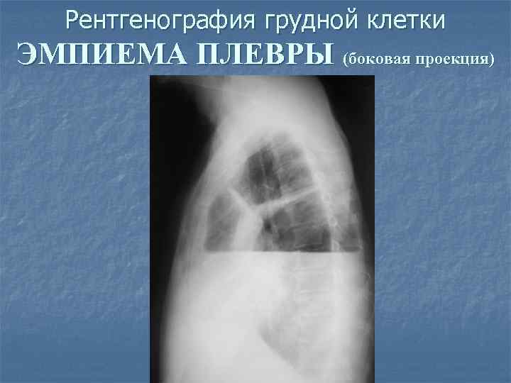Рентгенография грудной клетки ЭМПИЕМА ПЛЕВРЫ (боковая проекция) 