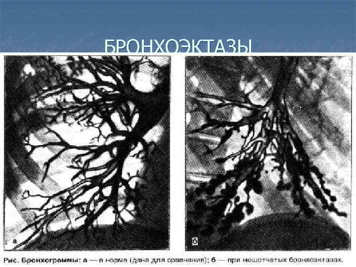 БРОНХОЭКТАЗЫ 