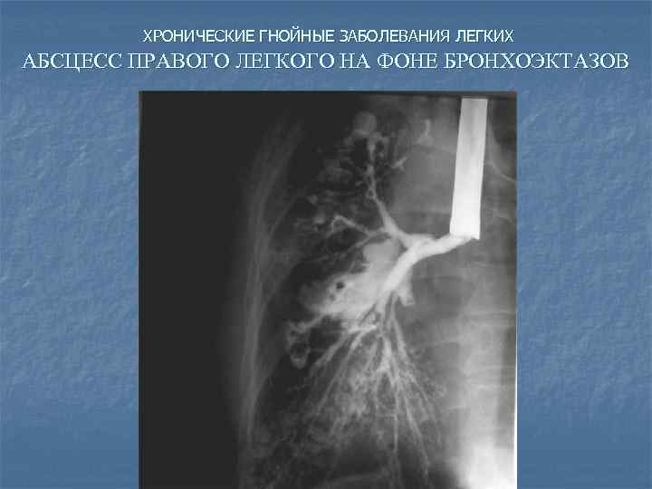 ХРОНИЧЕСКИЕ ГНОЙНЫЕ ЗАБОЛЕВАНИЯ ЛЕГКИХ АБСЦЕСС ПРАВОГО ЛЕГКОГО НА ФОНЕ БРОНХОЭКТАЗОВ 
