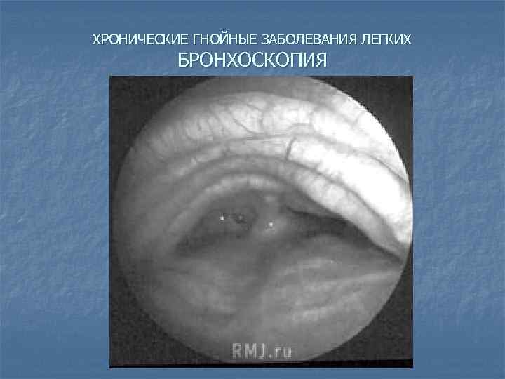 ХРОНИЧЕСКИЕ ГНОЙНЫЕ ЗАБОЛЕВАНИЯ ЛЕГКИХ БРОНХОСКОПИЯ 