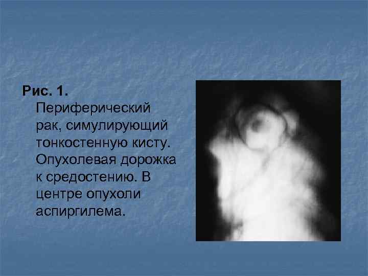 Рис. 1. Периферический рак, симулирующий тонкостенную кисту. Опухолевая дорожка к средостению. В центре опухоли