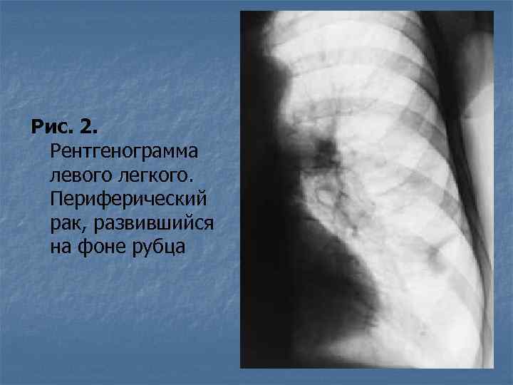 Рис. 2. Рентгенограмма левого легкого. Периферический рак, развившийся на фоне рубца 