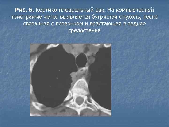 Рис. 6. Кортико-плевральный рак. На компьютерной томограмме четко выявляется бугристая опухоль, тесно связанная с