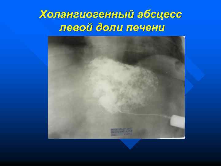 Холангиогенный абсцесс левой доли печени 