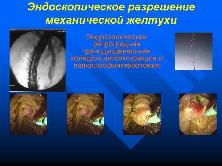Эндоскопическое разрешение механической желтухи Эндоскопическая ретроградная трансдуоденальная холедохолитоэкстракция и папиллосфинктеротомия 