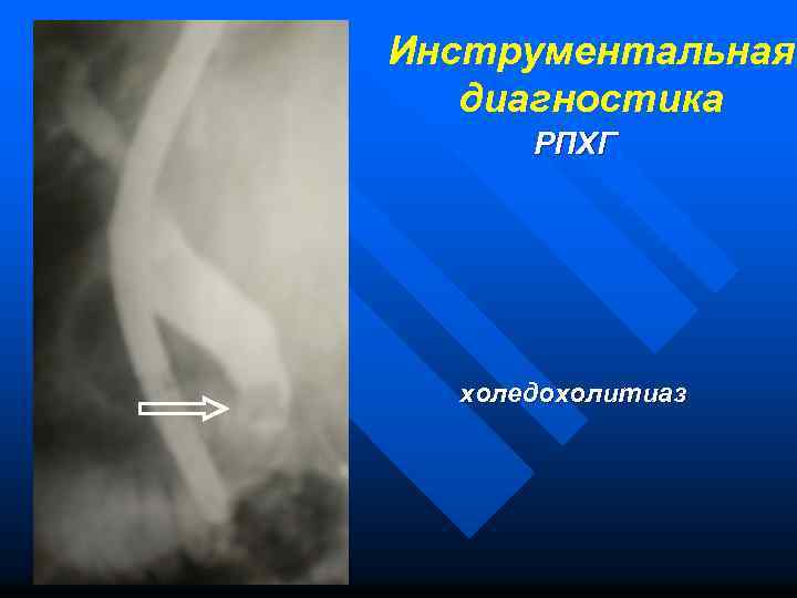 Инструментальная диагностика РПХГ холедохолитиаз 