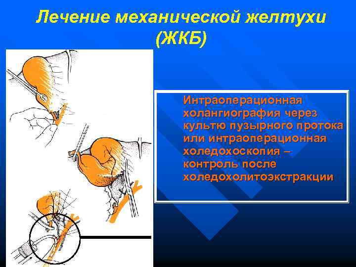 Лечение механической желтухи (ЖКБ) Интраоперационная холангиография через культю пузырного протока или интраоперационная холедохоскопия –