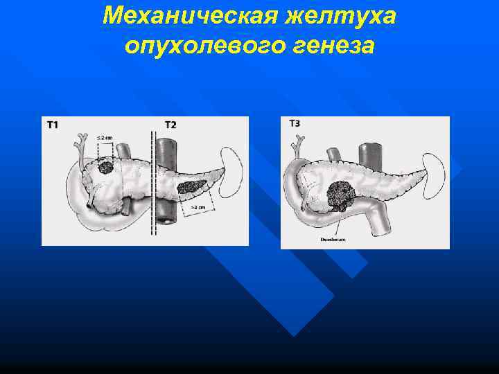 Механическая желтуха хирургия презентация