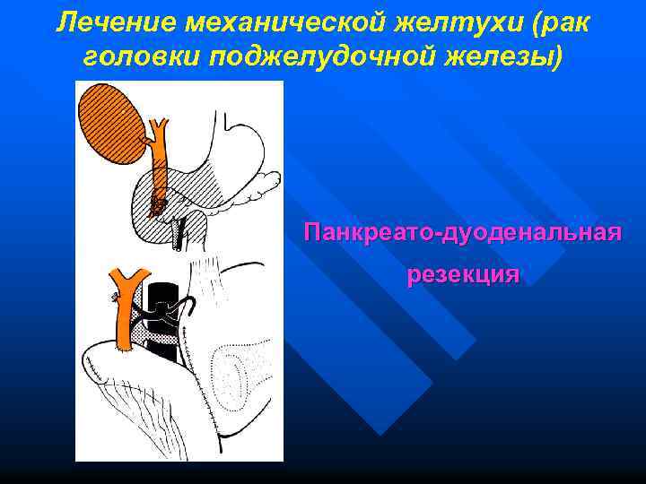 Лечение механической желтухи (рак головки поджелудочной железы) Панкреато-дуоденальная резекция 