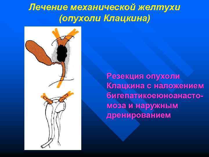 Лечение механической желтухи (опухоли Клацкина) Резекция опухоли Клацкина с наложением бигепатикоеюноанастомоза и наружным дренированием