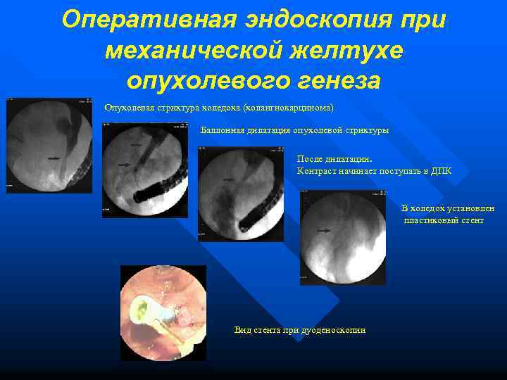 Оперативная эндоскопия при механической желтухе опухолевого генеза Опухолевая стриктура холедоха (холангиокарцинома) Баллонная дилатация опухолевой