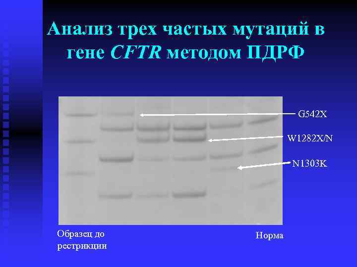 Анализ трех частых мутаций в гене CFTR методом ПДРФ G 542 X W 1282