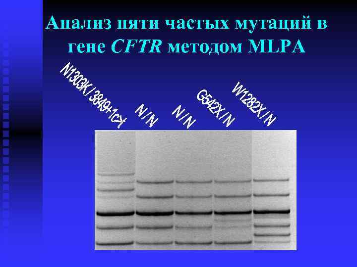 Анализ пяти частых мутаций в гене CFTR методом MLPA 