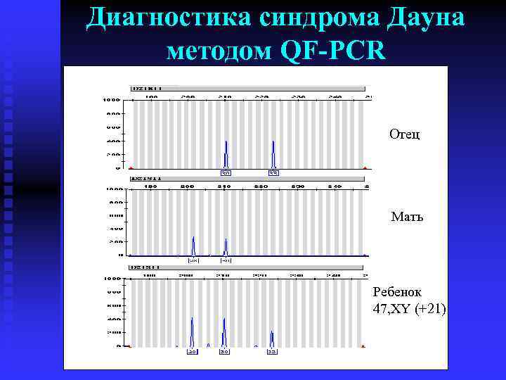 Диагностика синдрома Дауна методом QF-PCR Отец Мать Ребенок 47, XY (+21) 